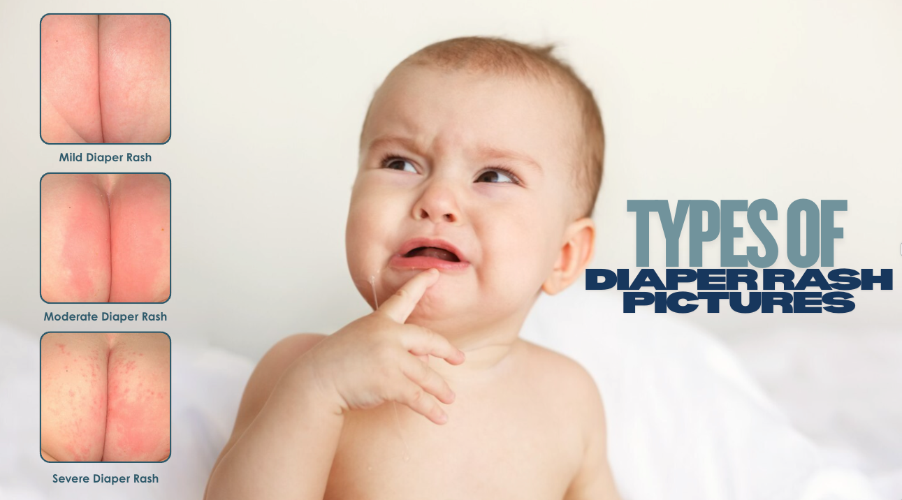Types Of Diaper Rash Pictures And How To Identify Them