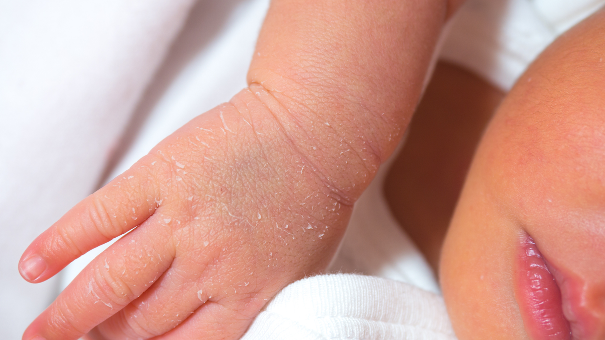 Newborn Skin Peeling